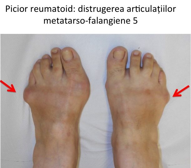 displazia bolii articulațiilor genunchiului articulațiile doare de la luarea artra