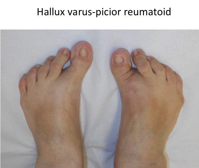 Picior reumatoid hallux varus