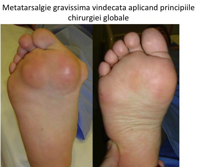 Picior reumatoid plantar