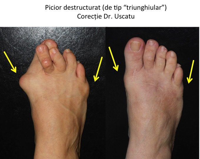 Picior triunghiular operat