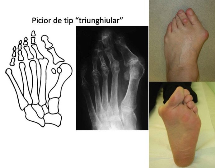 Totul despre artrita: tipuri, simptome, diagnostic, tratament