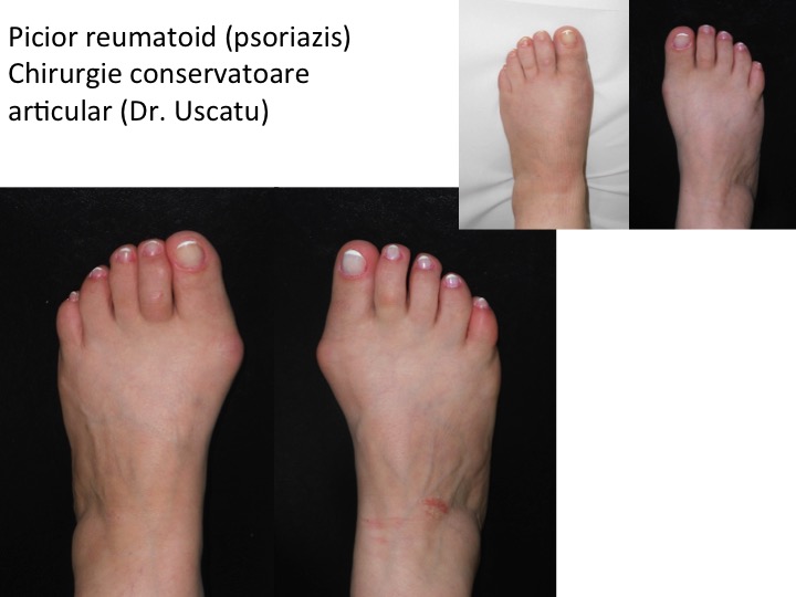 tratamentul articular al degetului de la picior