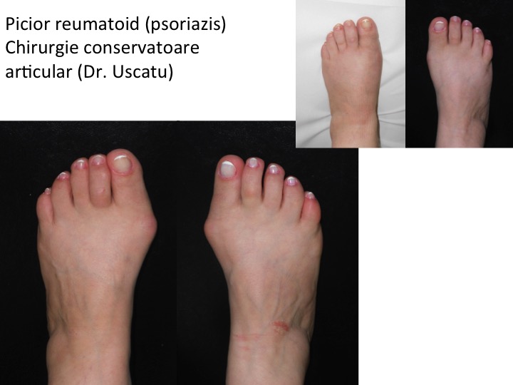 tratament articular și articular al piciorului)