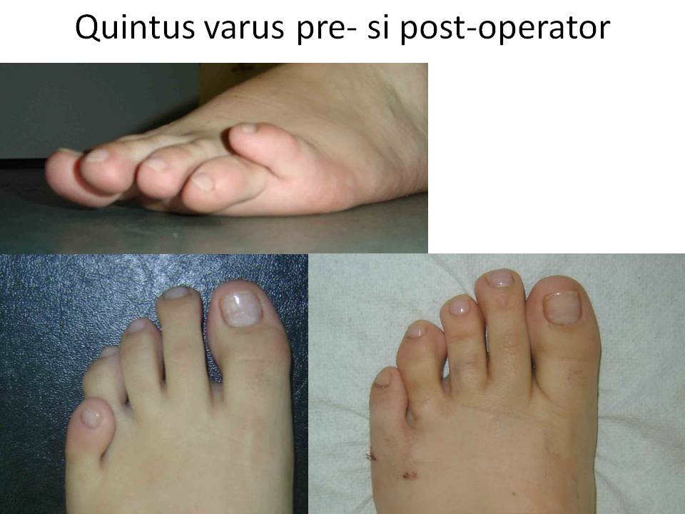 Quintus varus pre- si post-operator