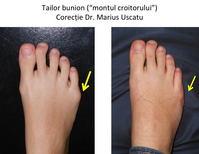 Tailor bunion DC dr