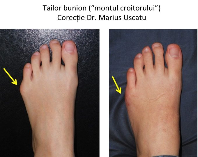 Tailor bunion DC stg