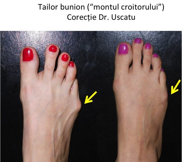 Tailor bunion Rad