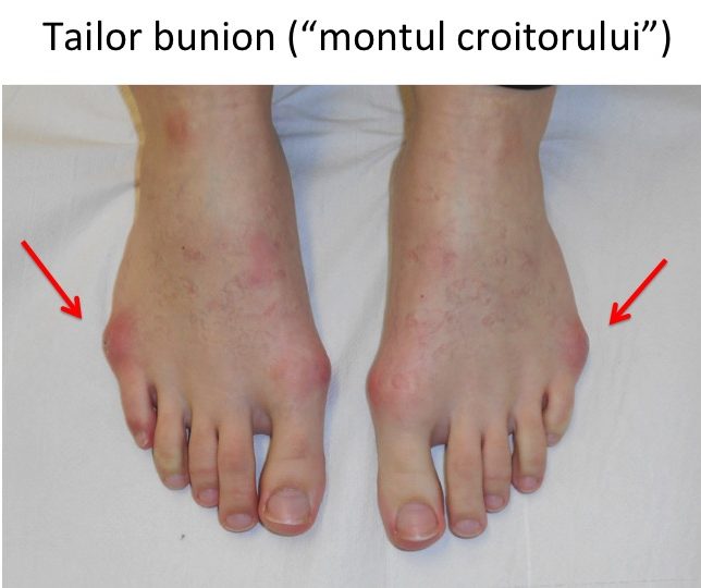 Tailor bunion bilateral