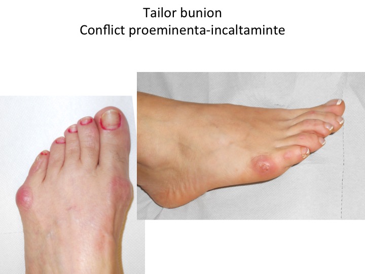 Tailor bunion conflict