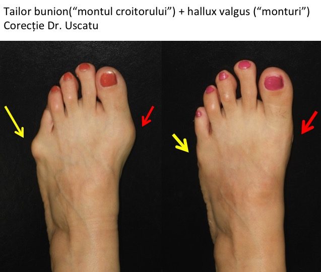 Tailor bunion + hallux valgus