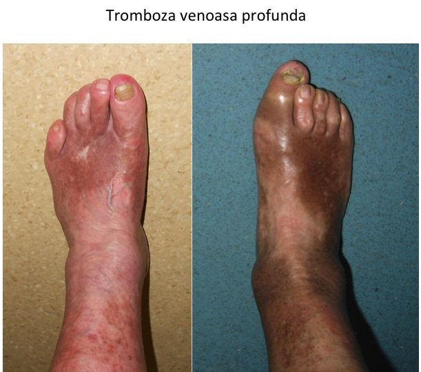 Tromboza venoasa profunda