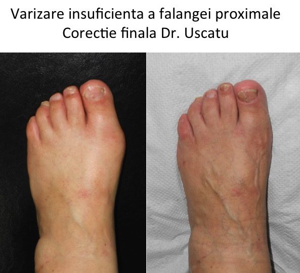 Varizare insuficienta