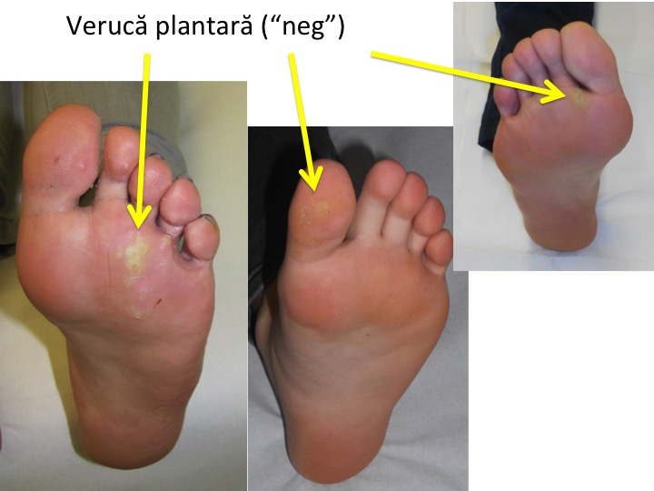 verucă plantară