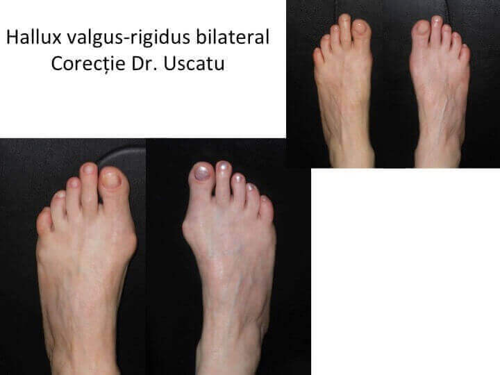 dureri articulare hallux valgus