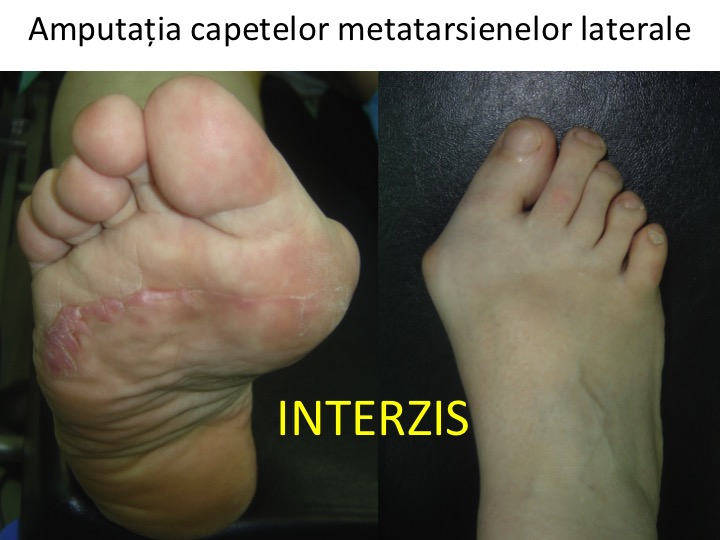 Tratamentul artritei articulare metatarsiene