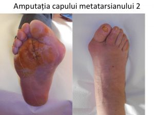 Amputatie cap metatarsian 2 Flo
