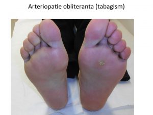 Batatura arteriopatie obliteranta