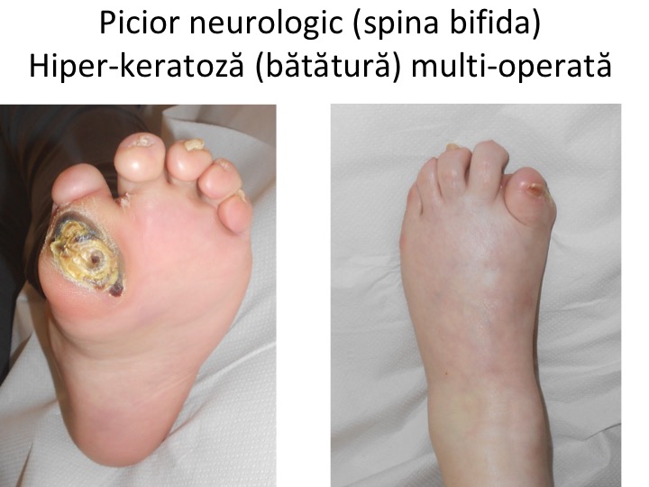 Bataturile Piciorului Cauze Si Tratament