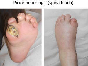 Spina bifida
