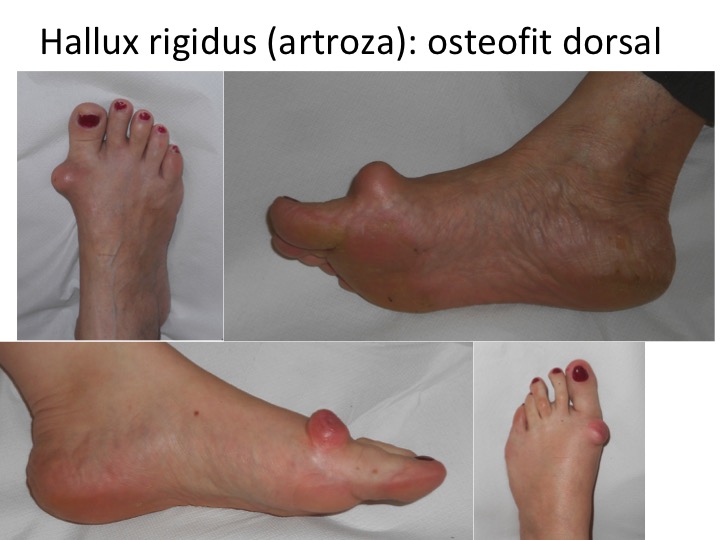 artroza piciorului metatarsian)