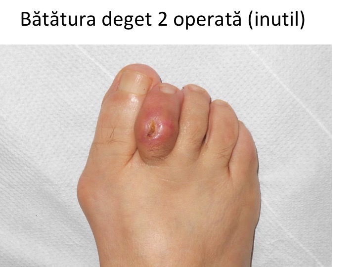 Ligamente degete picior