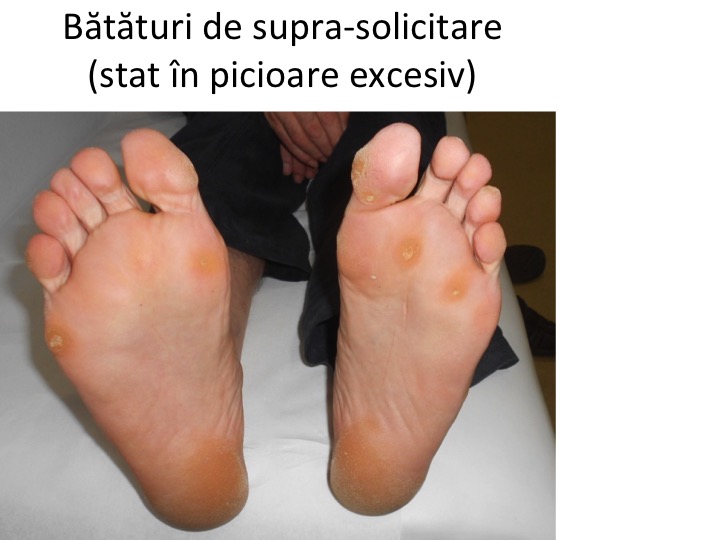 Infecția articulațiilor piciorului