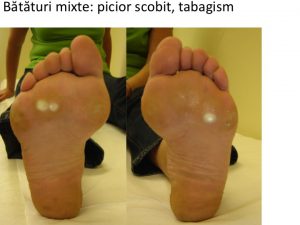 Chi picior scobit fumat