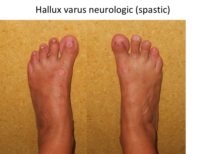 Hallux varus neurologic