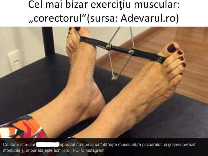 Monturi Picioare Hallux Valgus Operatie Sau Tratament Conservator