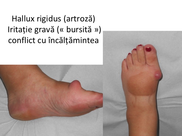 artroza piciorului metatarsian refacerea articulațiilor mâinilor