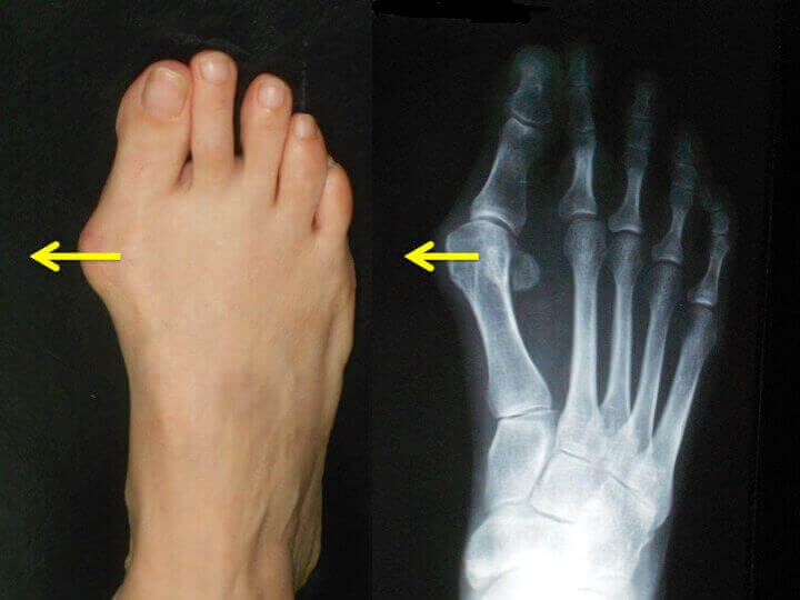 leziuni la nivelul articulației degetelor de la picior