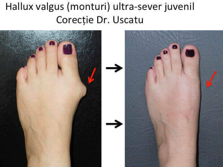 tratamentul chirurgical al artrozei degetelor de la picioare)