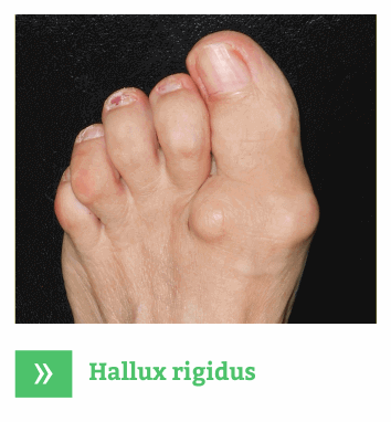 Hallux Rigidus - Artroza picioare