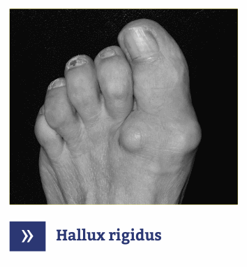 Hallux Rigidus - Artroza picior