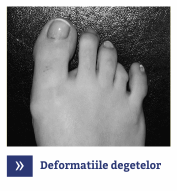 Deformatii deget