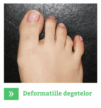 Deformatiile degetelor