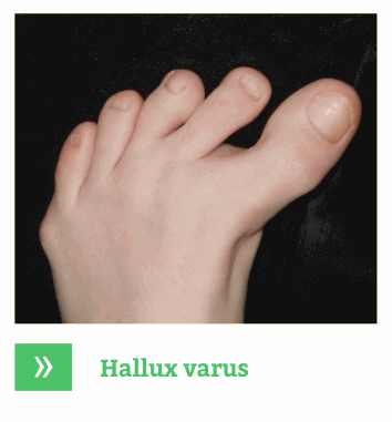 Hallux varus picioare