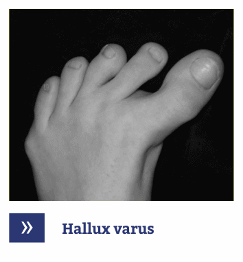 Hallux varus picior