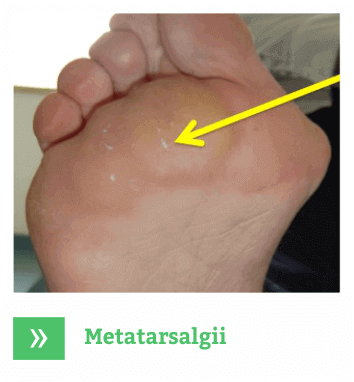 Metatarsalgii picioare