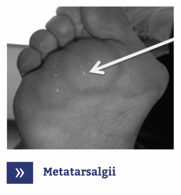 Metatarsalgii picior