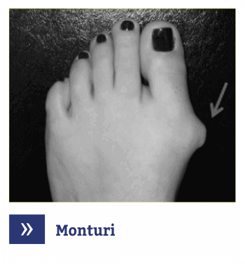 Monturi - hallux valgus