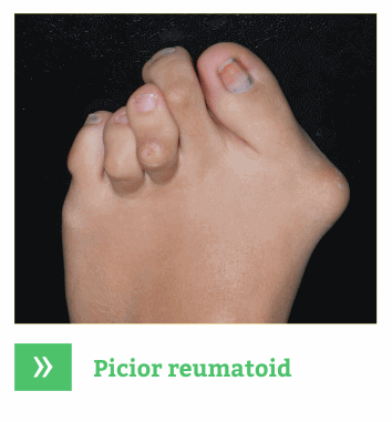 Picioare reumatoide