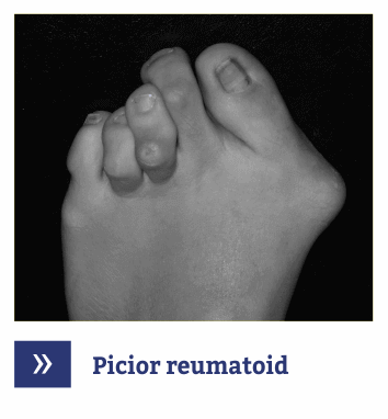 Picior reumatoid