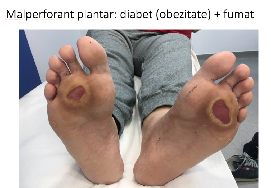 neagră plantară adâncă