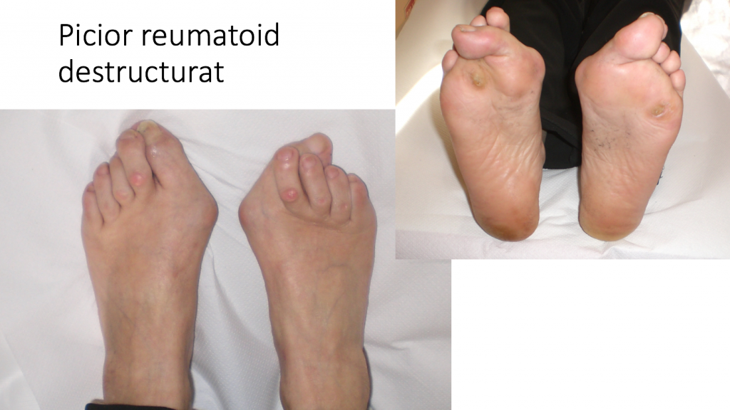 artrita reumatoida a articulatiilor piciorului)