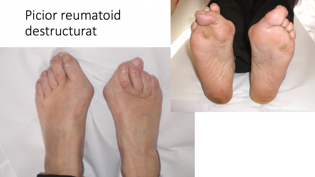 Osteoartrita: Simptome, Cauze, Tratament