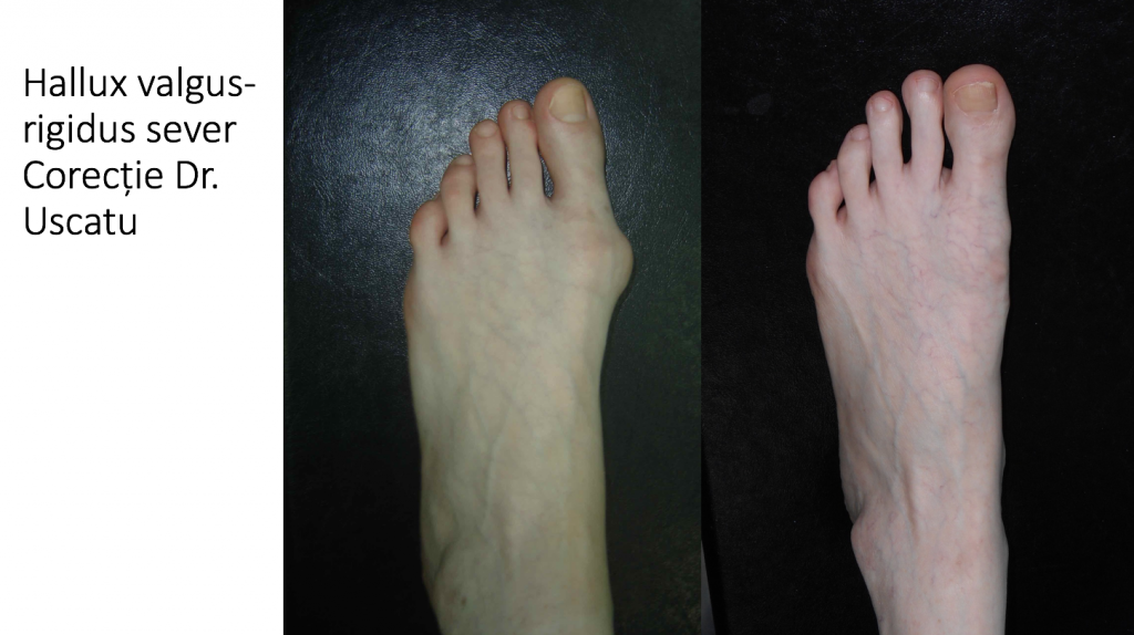 Hallux Valgus (Monturi) - cauze, simptome, diagnostic, tratament