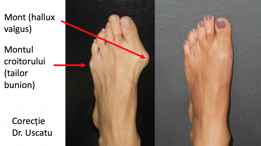 Monturi la Picioare: Tratament - Cand e nevoie de operatie? - ProEstetica
