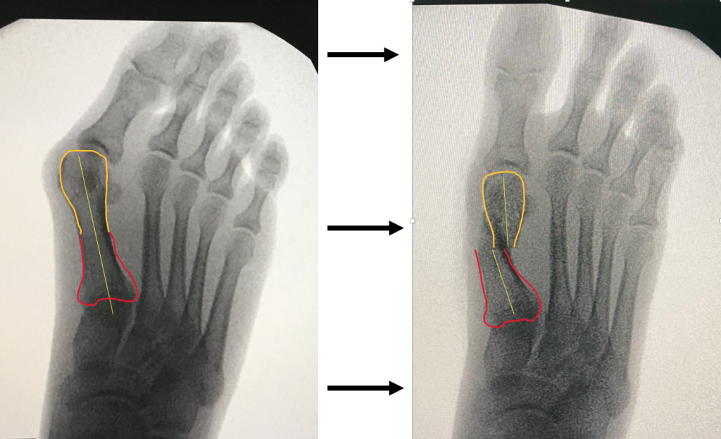 recuperare dupa operatie hallux valgus