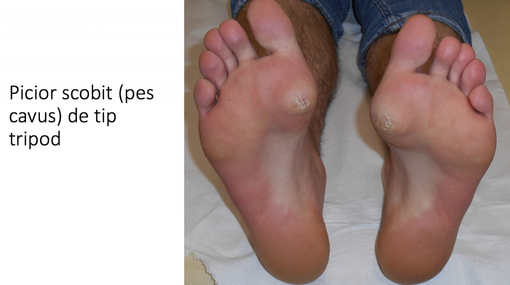 ce este diferit periculos pe piciorul stâng al ei de ce în timpul varicelor nu pot fi depilate